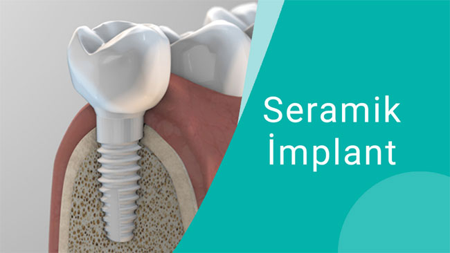 seramik implant