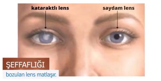 Retina Dekolmanı Nedenleri Nelerdir? 2